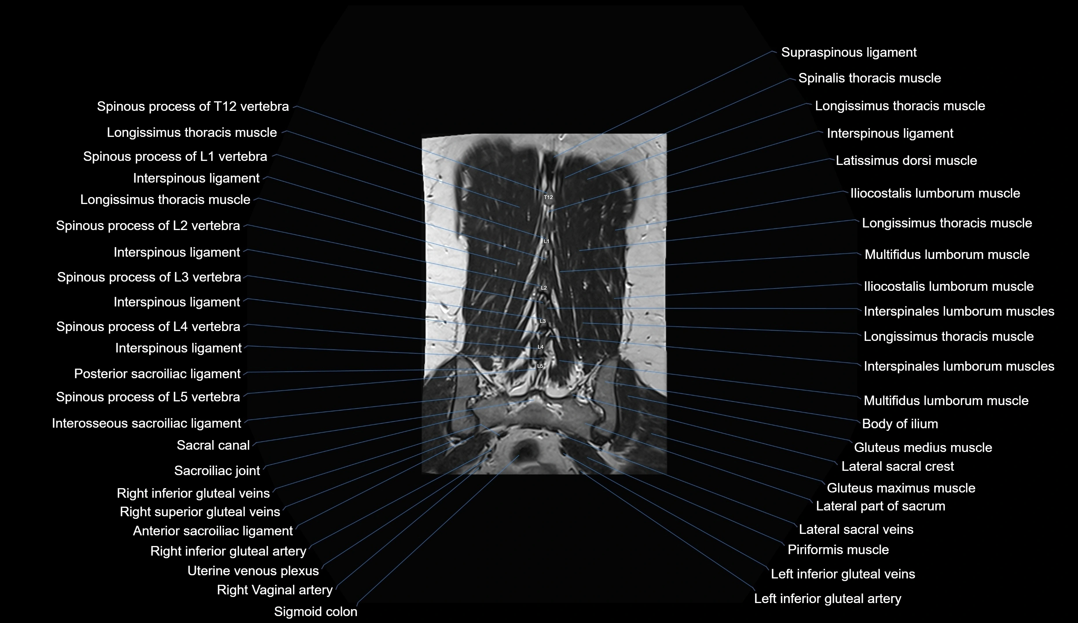 MRI lumbar spine coronal cross sectional anatomy 3T radiology  image-img-00001-00031.webp